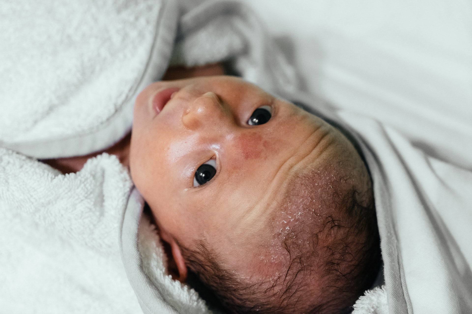 Kulit Kepala Bayi Bersisik, Normalkah Yuk Simak!